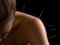 Acupuncture (acuponcture)